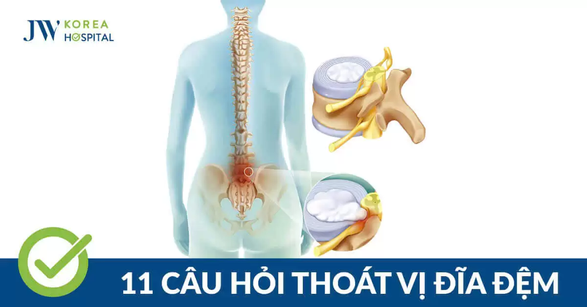 11+ Câu hỏi thường gặp về bệnh lý thoát vị đĩa đệm 