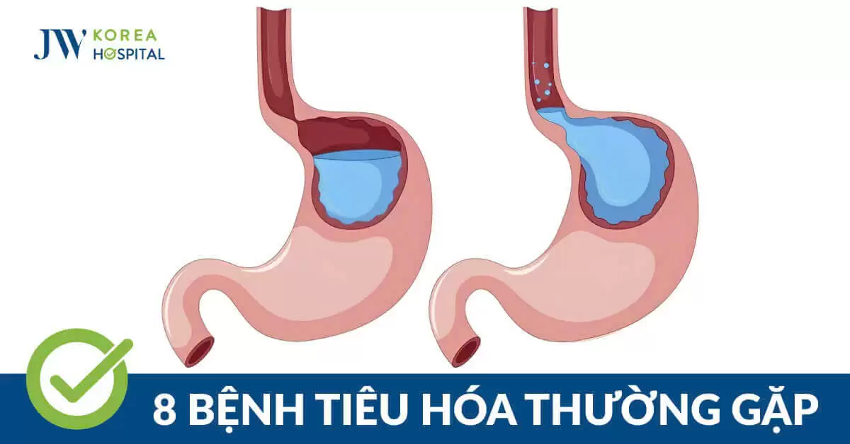 8 bệnh tiêu hóa: Dấu hiệu cảnh báo và cách phòng ngừa hiệu quả