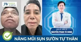 nâng mũi sụn sườn tự thân