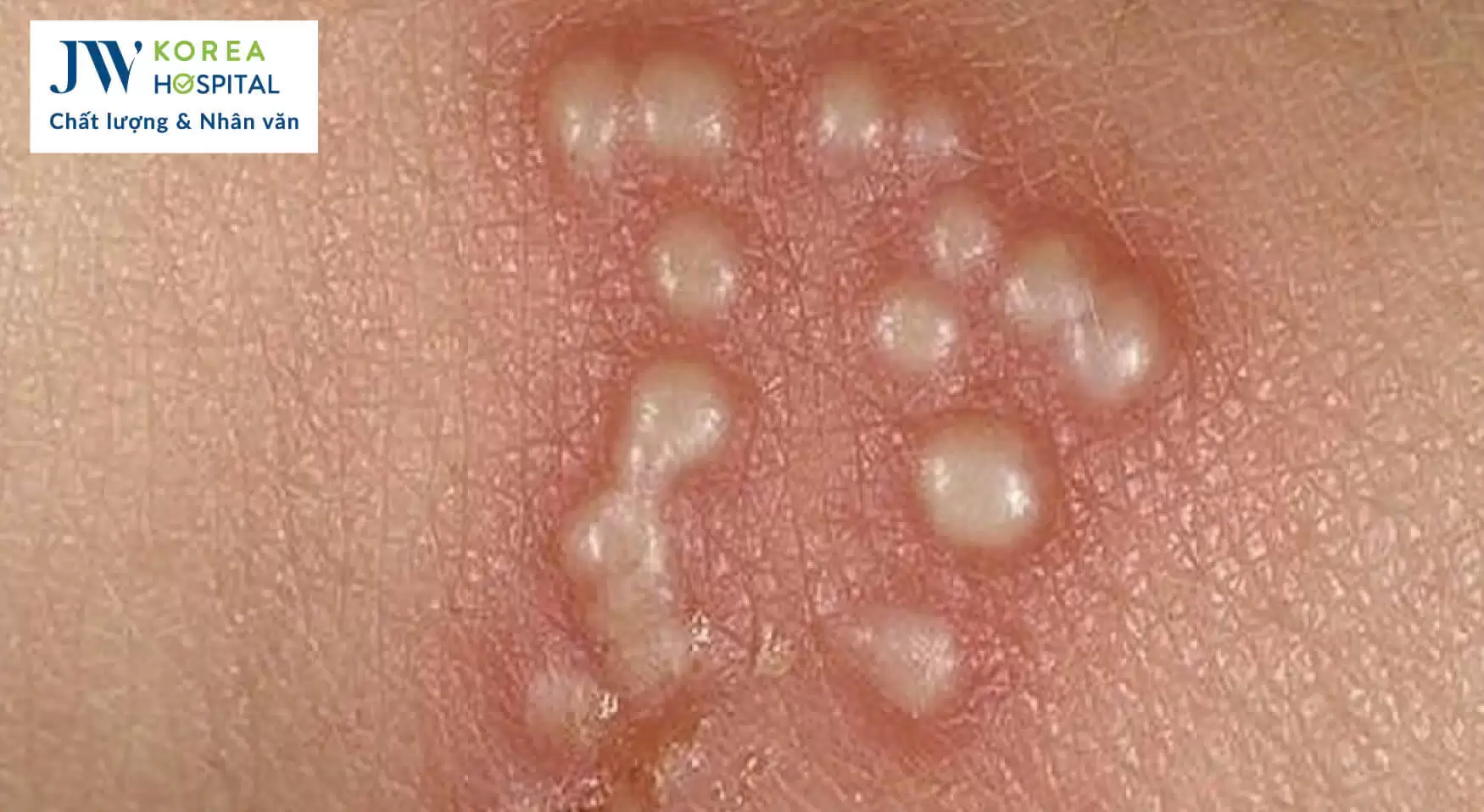 mun-rop-sinh-duc