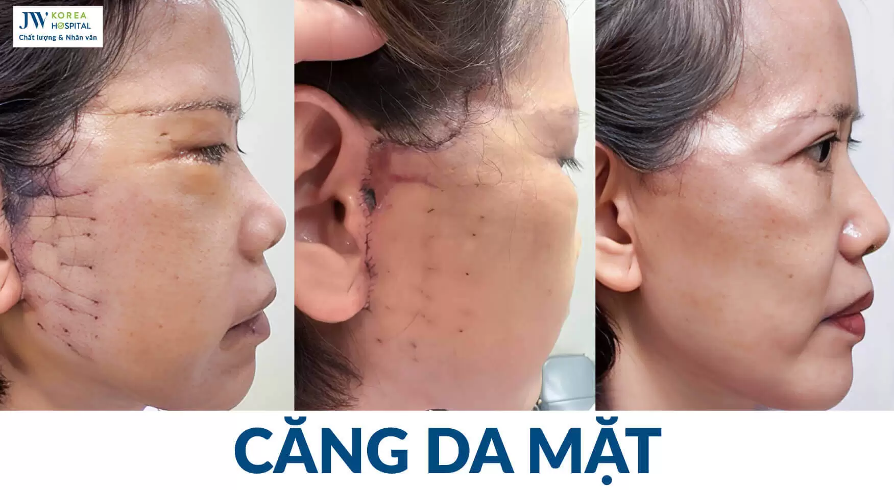 ky-thuat-cang-da-mat