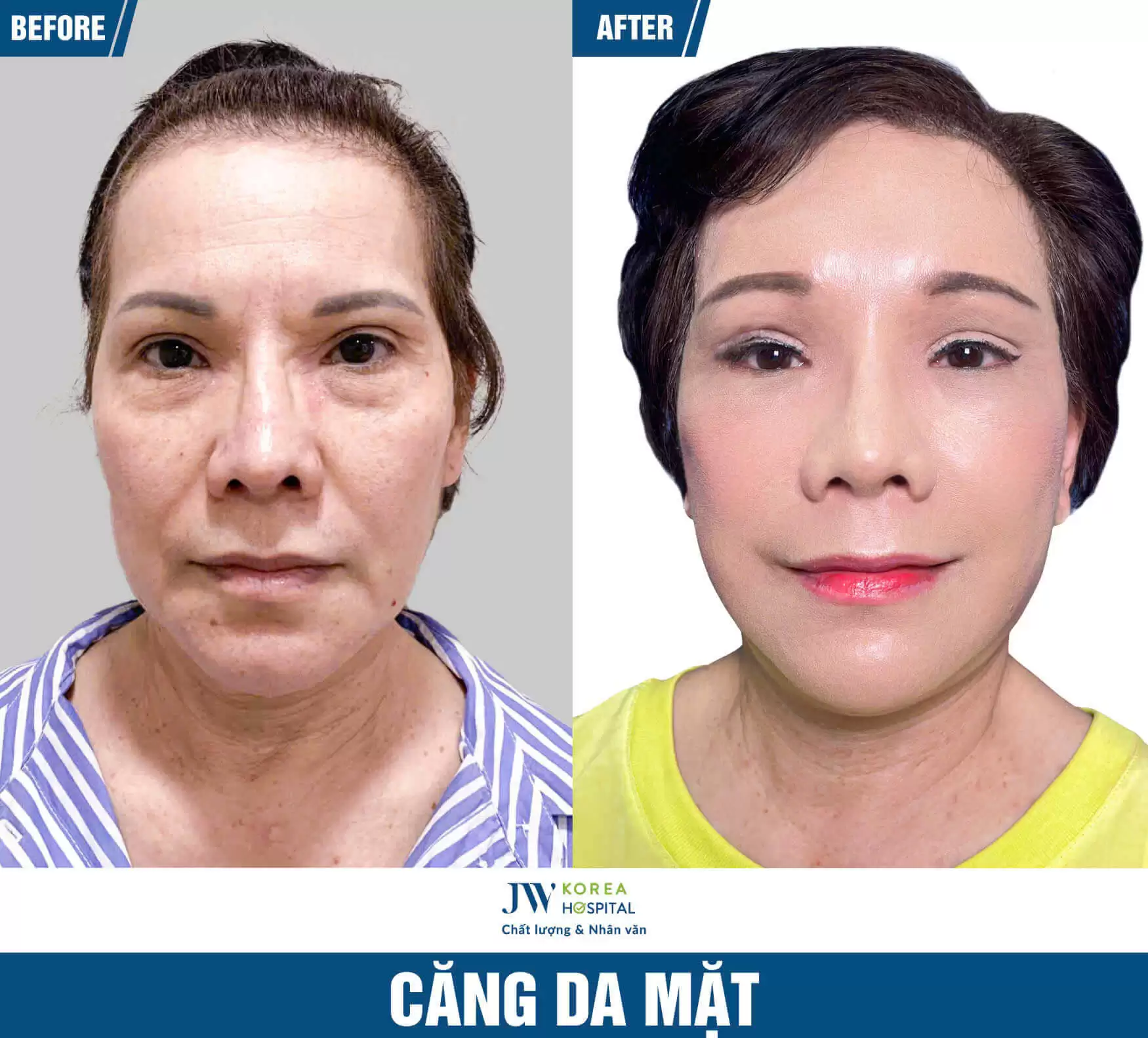 cang-da-mat-smas