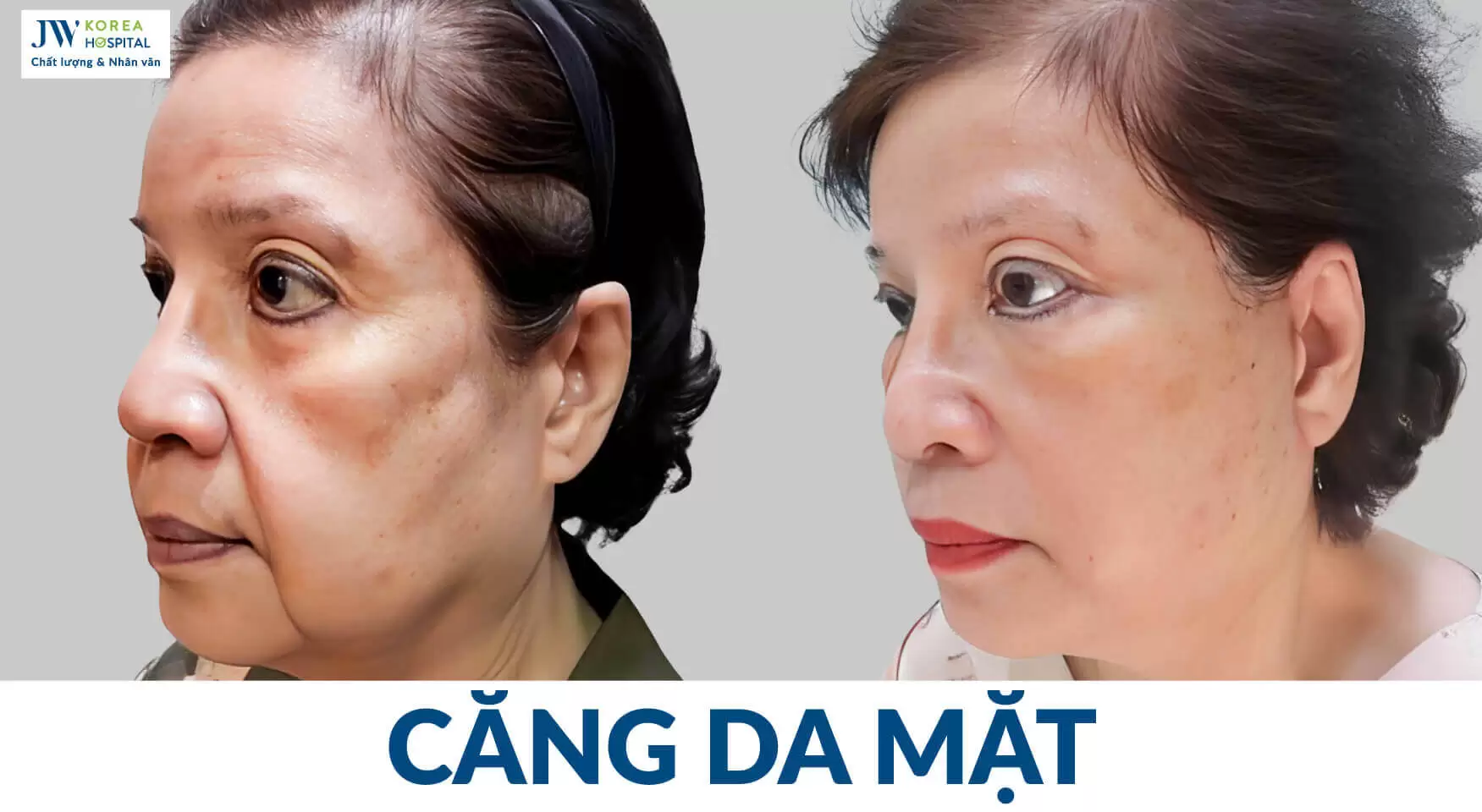 căng-da-mat-smas