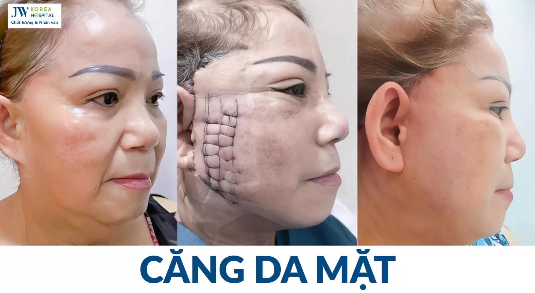 căng da mặt