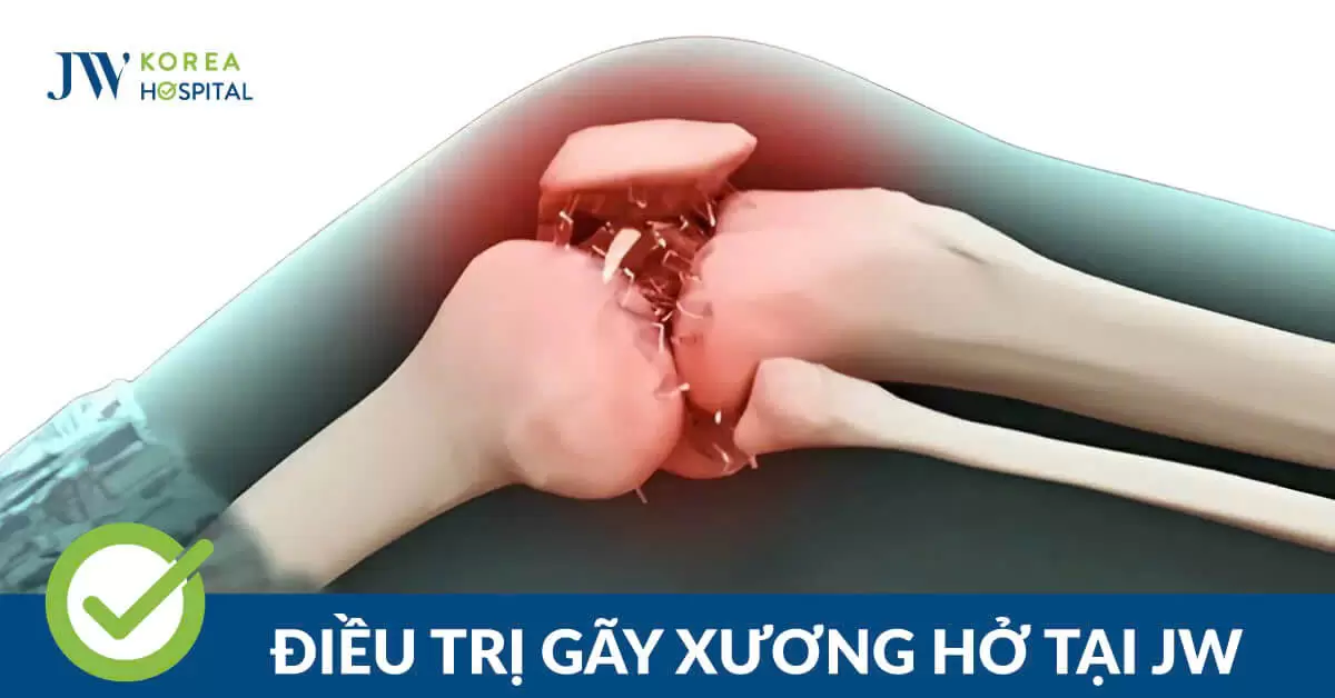 Điều Trị Gãy Xương Hở, Nắn Trật Khớp, Bó Bột An Toàn Tại JW
