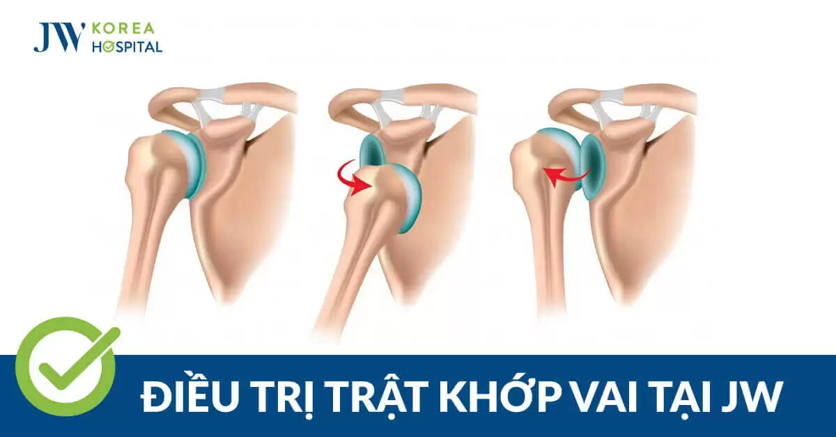 Trật Khớp Vai: Nguyên Nhân, Dấu Hiệu và Điều Trị Hiệu Quả Tại JW