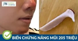 nâng mũi không dao kéo