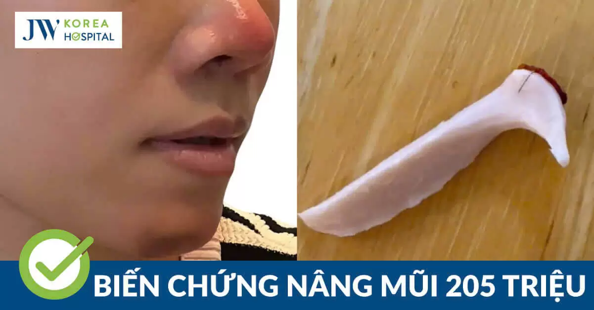 Chi 205 triệu đồng nâng mũi không dao kéo nhận cái kết tháo sụn, mũi hoại tử