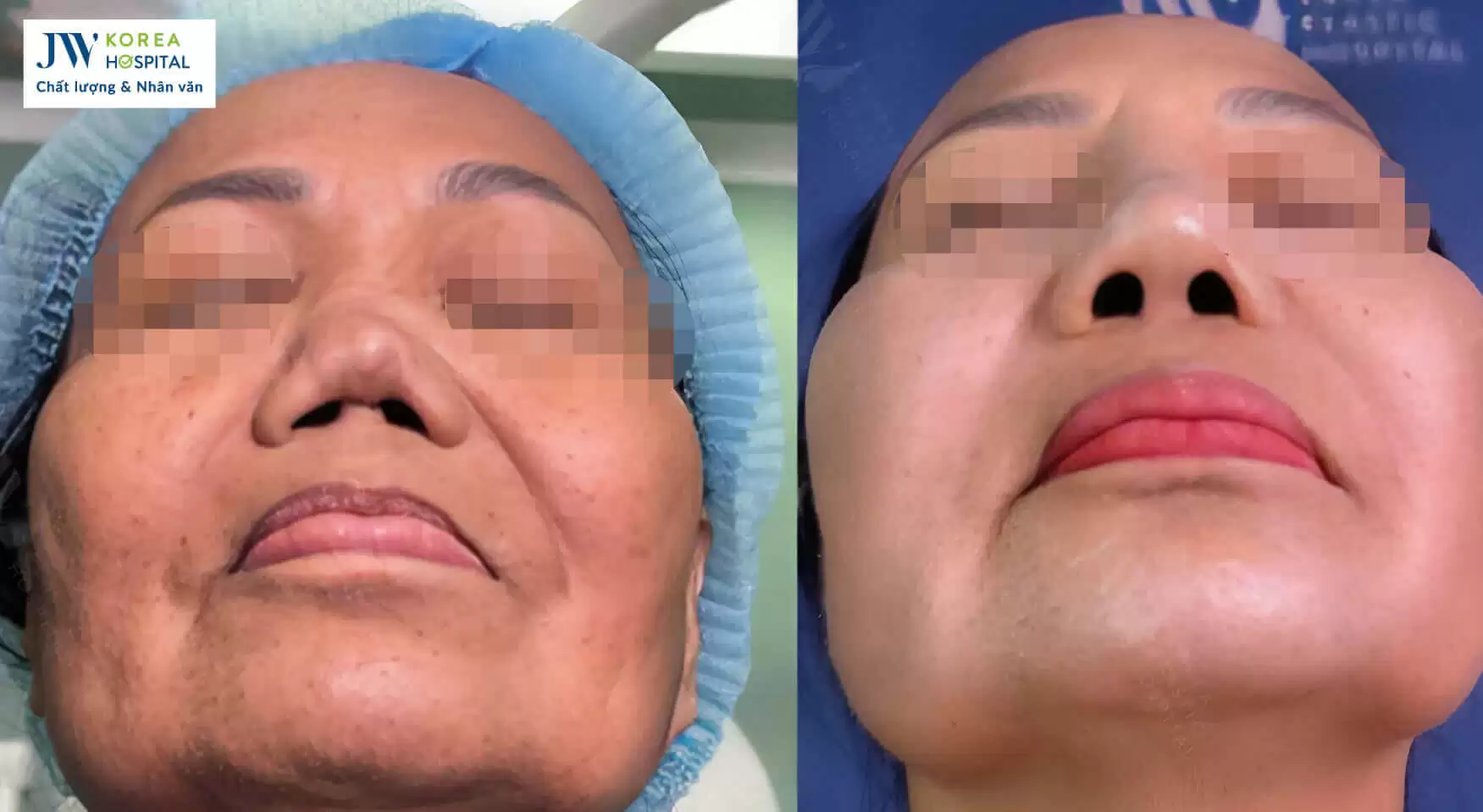nang-mui-silicone