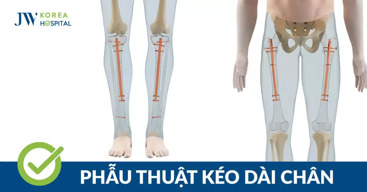 Phẫu Thuật Kéo Dài Chân: Lợi Ích, Rủi Ro và Những Điều Cần Biết