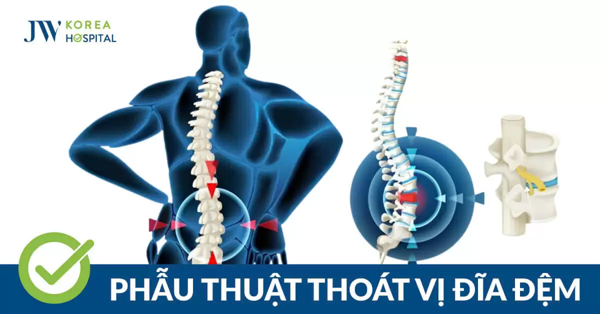 Phẫu thuật thoát vị đĩa đệm: Làm gì để phục hồi, tránh tái phát?