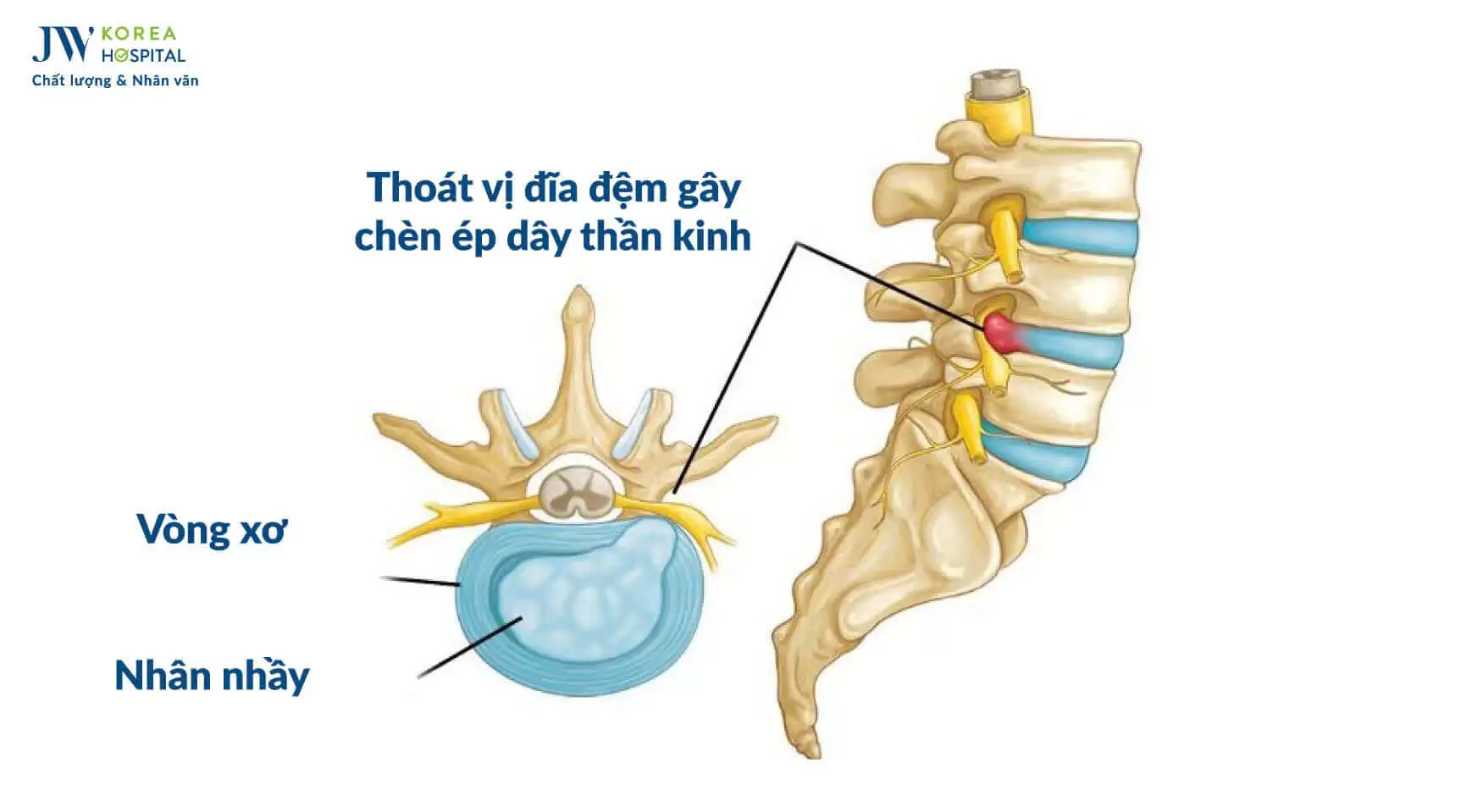 benh-cot-song
