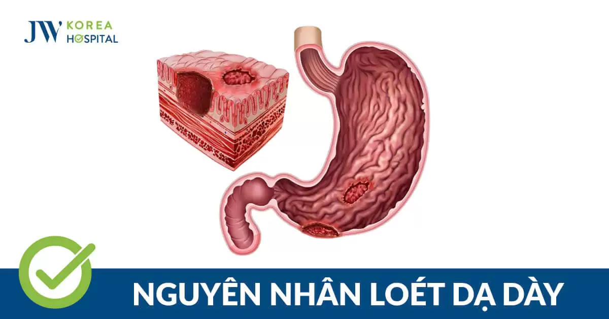 Bệnh viêm loét dạ dày: Nguyên nhân, triệu chứng và hướng điều trị