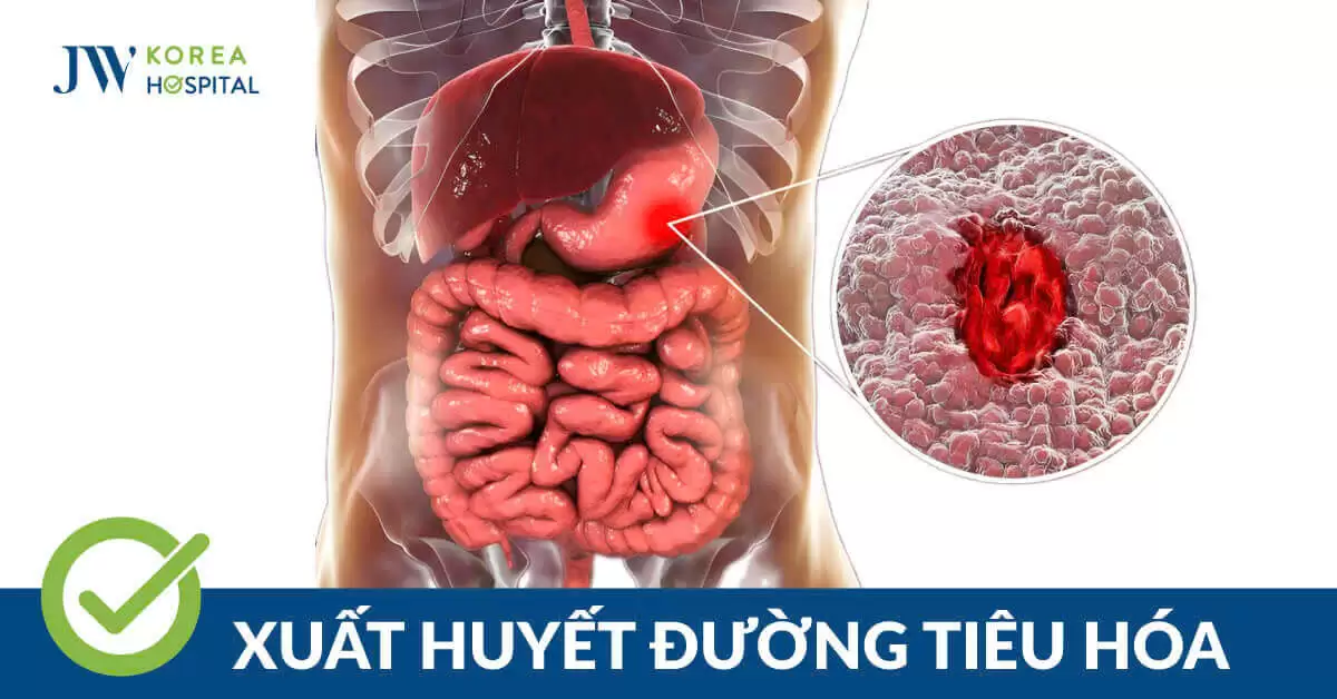 Xuất huyết tiêu hóa: Nhận biết sớm triệu chứng để tránh biến chứng nguy hiểm