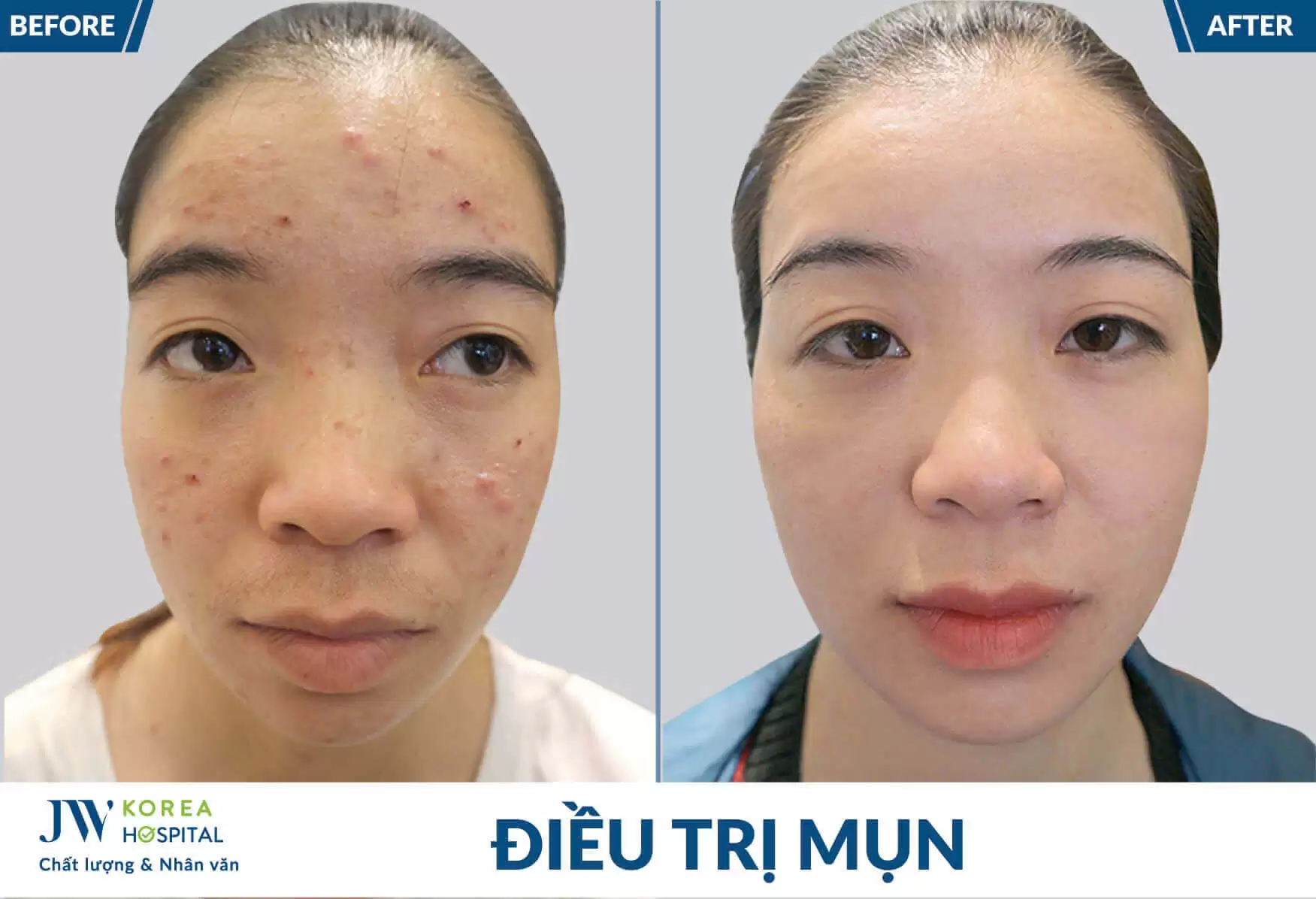 dieu-tri-mun