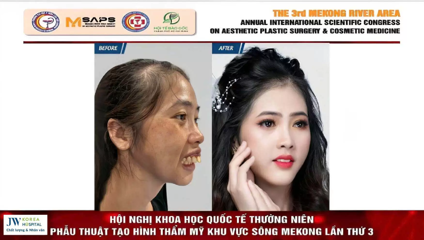 phau-thuat-ham-ho