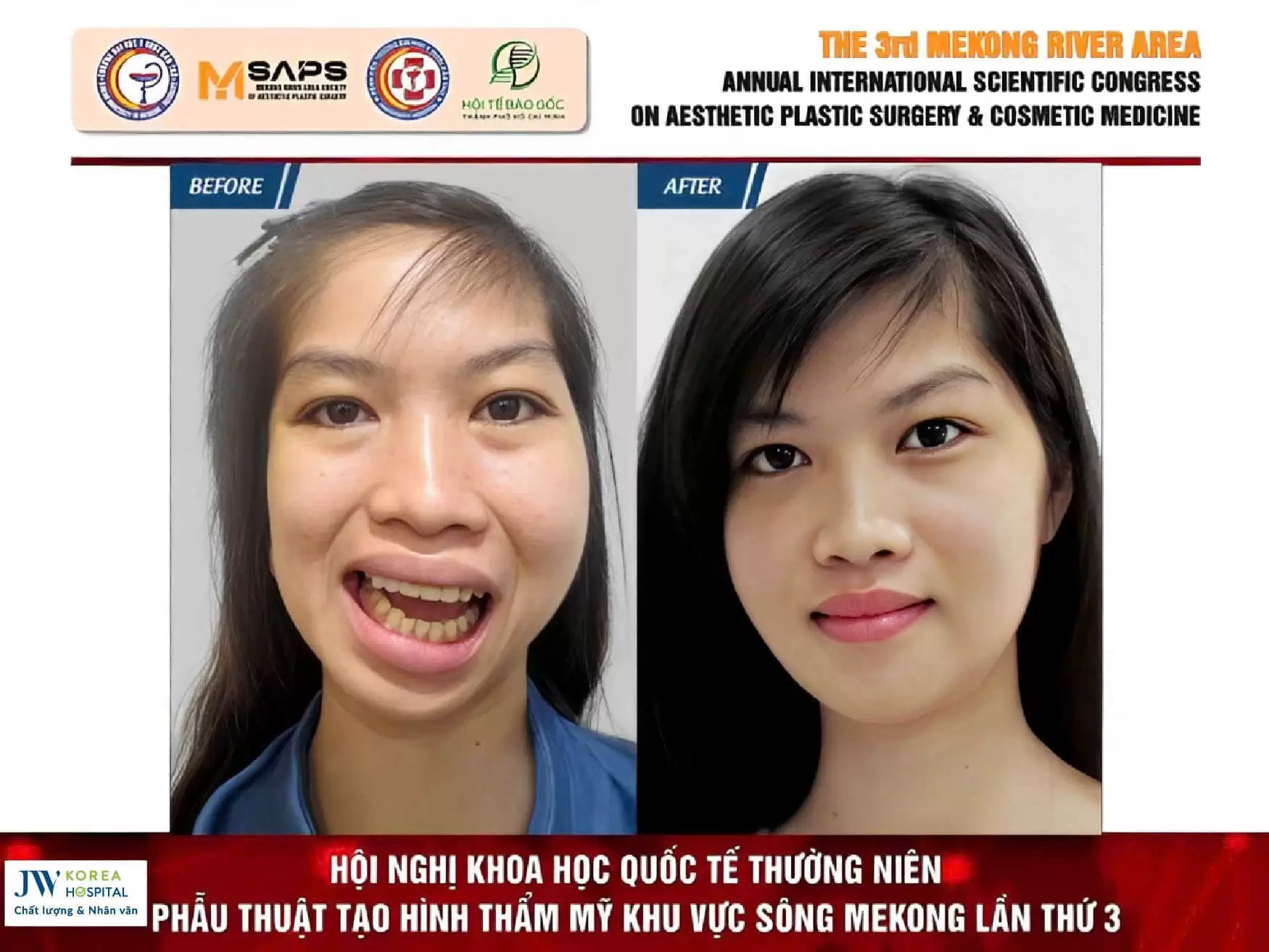 phau-thuat-ham-mom