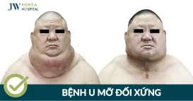 benh u mo doi xung 1