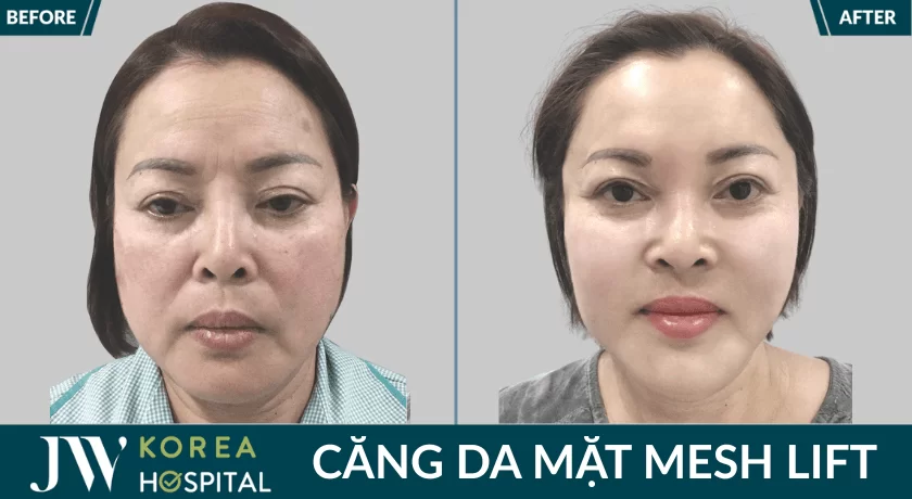 bf af cai lao 3m