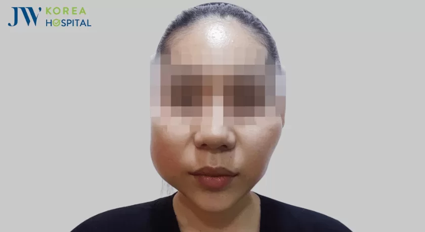 bien chung tiem filler