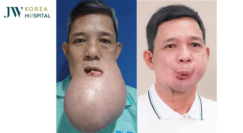 chu khanh khoi u