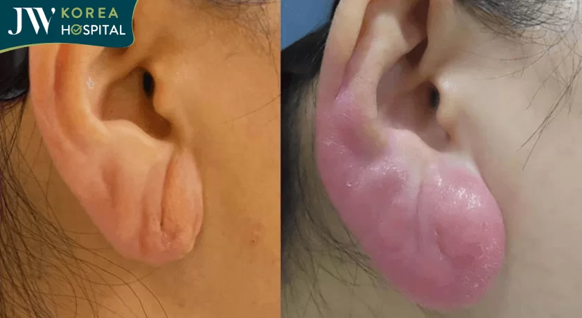 tiem filler 6