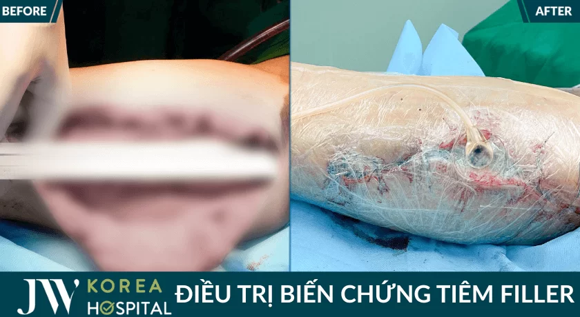 truoc va sau tiem filler duoc jw dieu tri 1