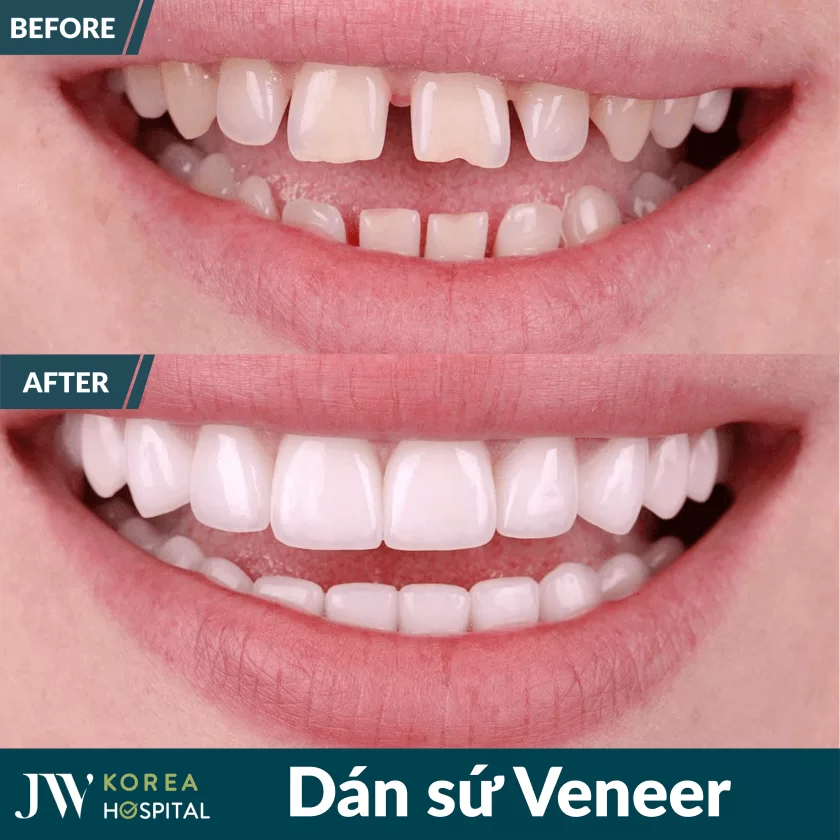 dan su veneer jw 