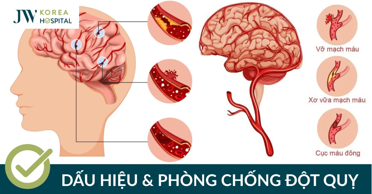 Đột quỵ: Dấu hiệu nhận biết & cách phòng ngừa cùng JW