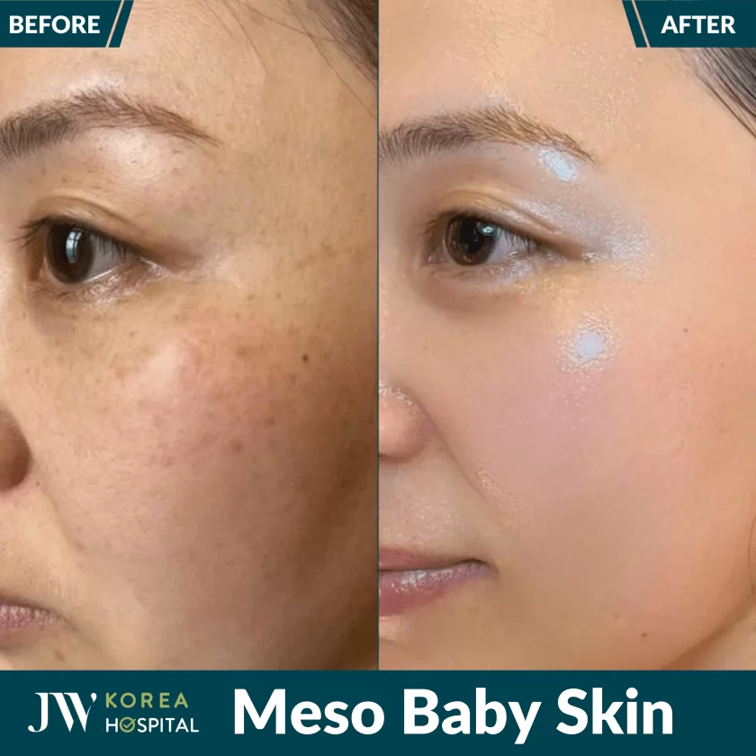 meso baby skin