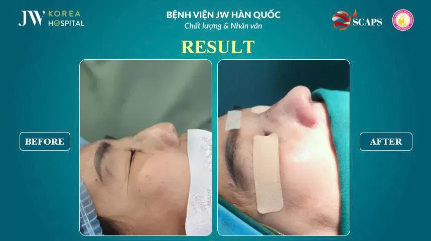 nang mui sun suon