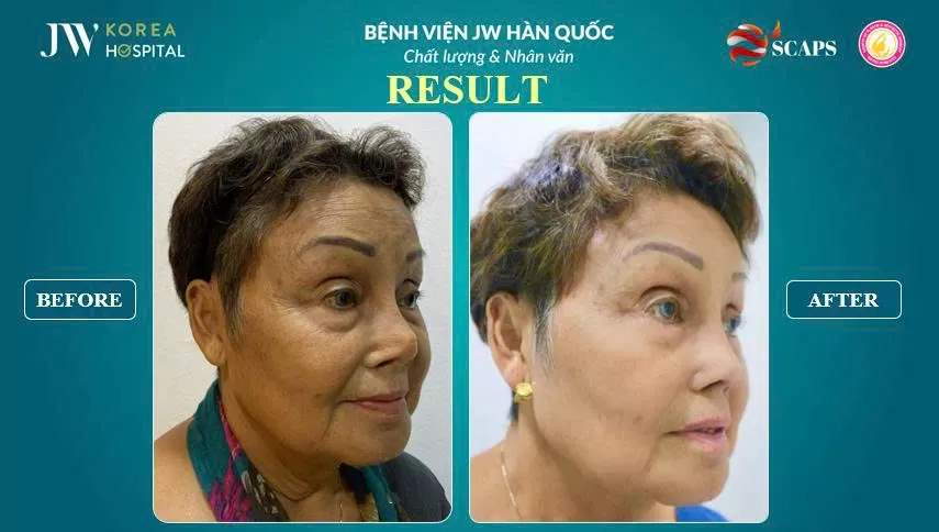 nang mui sun suon