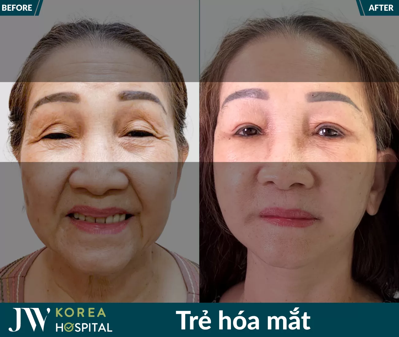 tre hoa mat 08 2025 01 216x183